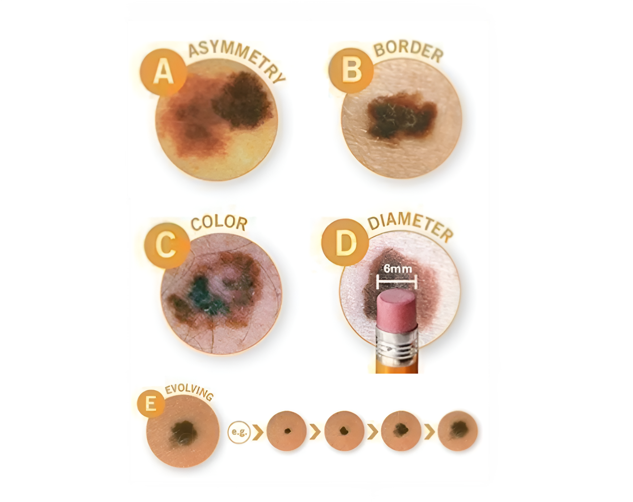 Skin cancer detection guide for patients in Cortland NY