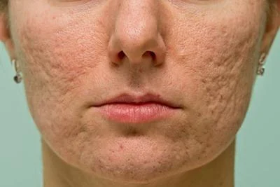 Adult facial acne treatment in Ithaca NY dermatology clinic